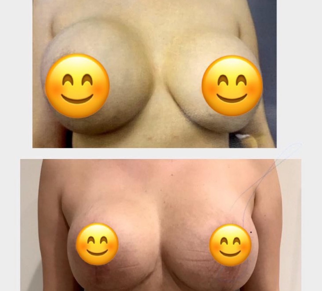 Breast Revision Case 11 - Before and After