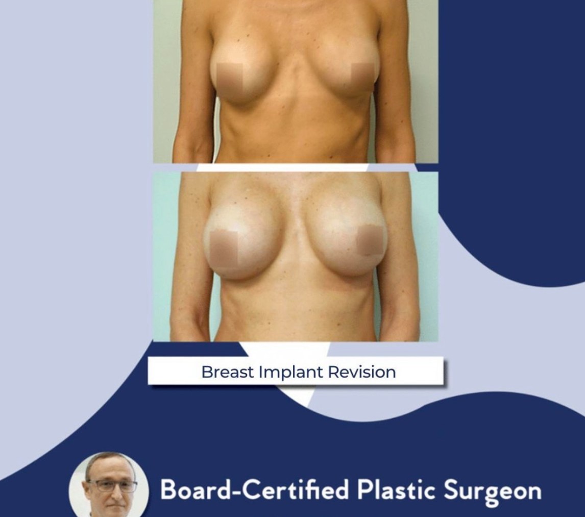 Breast Revision Case 13 - Before and After