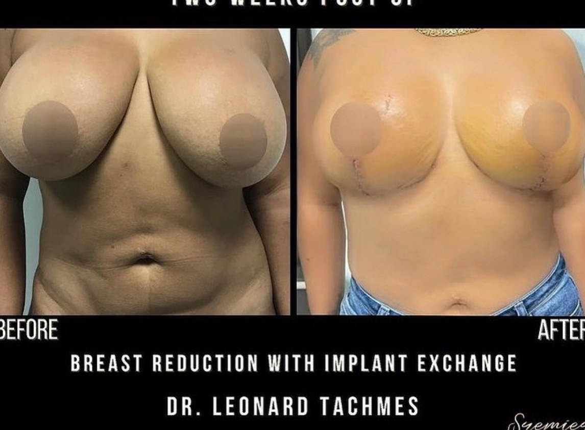 Breast Revision Case 14 - Before and After