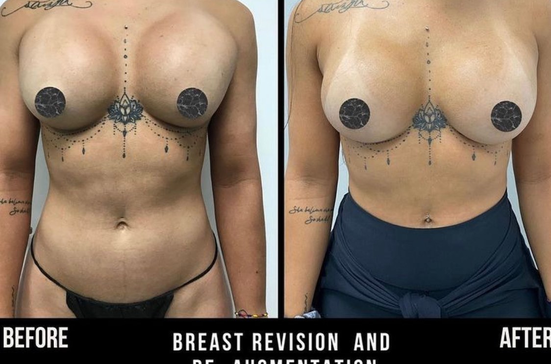 Breast Revision Case 15 - Before and After