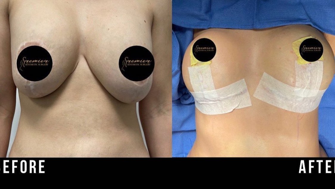 Breast Revision Case 16 - Before and After