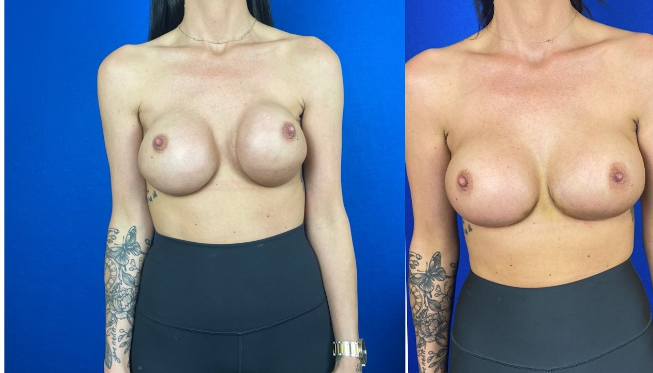 Breast Revision Case 17 - Before and After